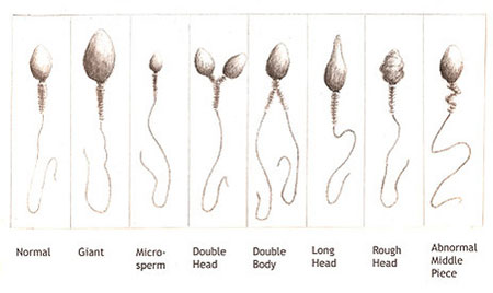 Perbedaan bentuk sperma normal dengan sperma cacat